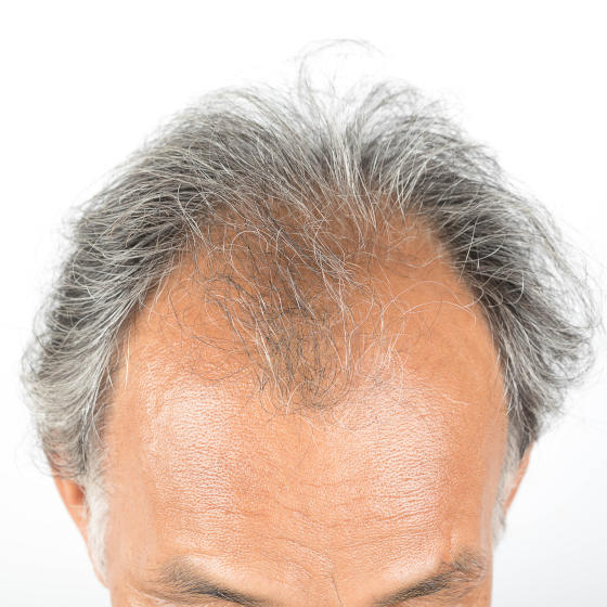 Different Types of Alopecia | Symptoms & Treatments | NIOXIN
