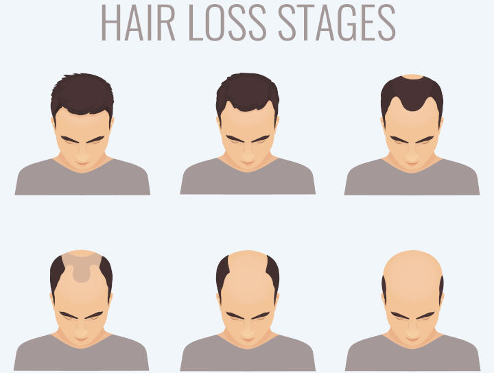Dunner Werdendes Haar Haarausfall Bei Mannern Ursachen Behandlungen Nioxin