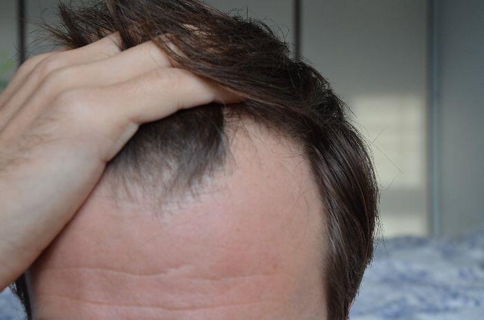 What is Scalp Acne and Can it Lead to Hair Loss? | NIOXIN