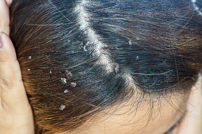 How to Moisturize Your Scalp NIOXIN